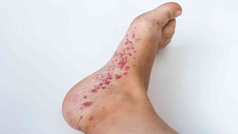 Foot Path Rash Practice Perfect 965 - Dermatologic Disorders: - Underappreciated in ...